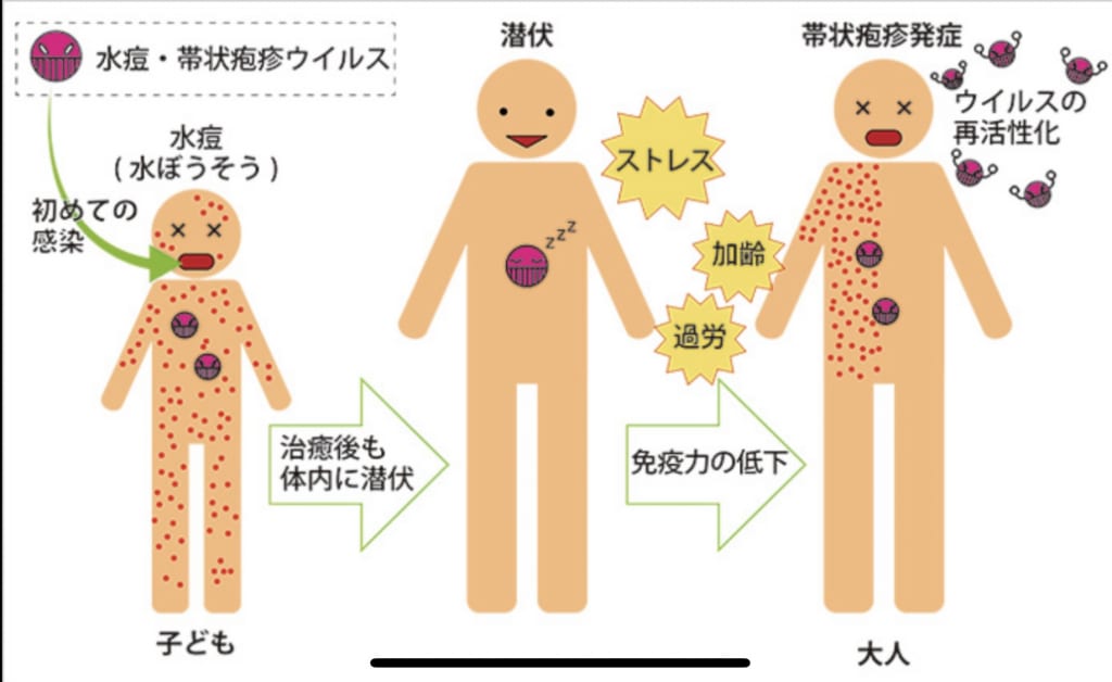 帯状疱疹について デイサービスひろゴン