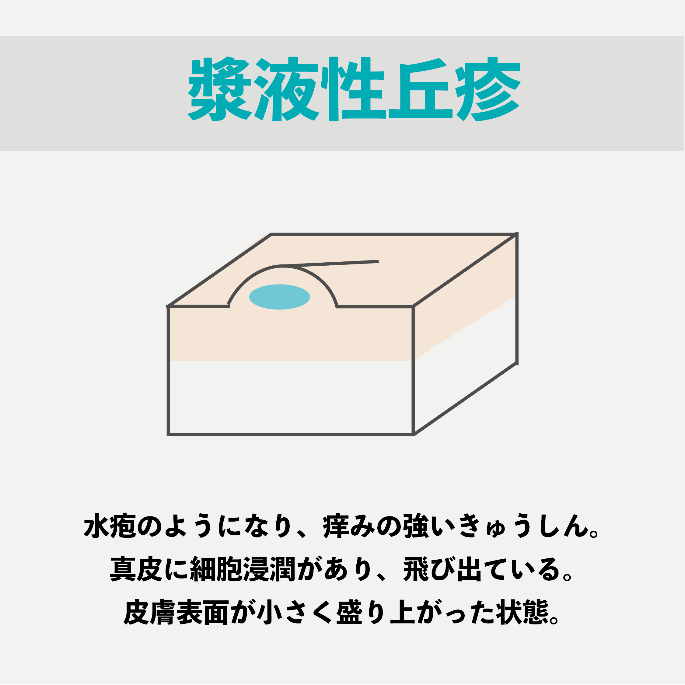 アトピー性皮膚炎の進行を湿疹の状態で見る 大阪でアトピー 頭痛 自律神経の不調ならオルソ鍼灸院 アトピー性皮膚炎の進行を湿疹の状態で見る 大阪でアトピー 頭痛 自律神経の不調ならオルソ鍼灸院